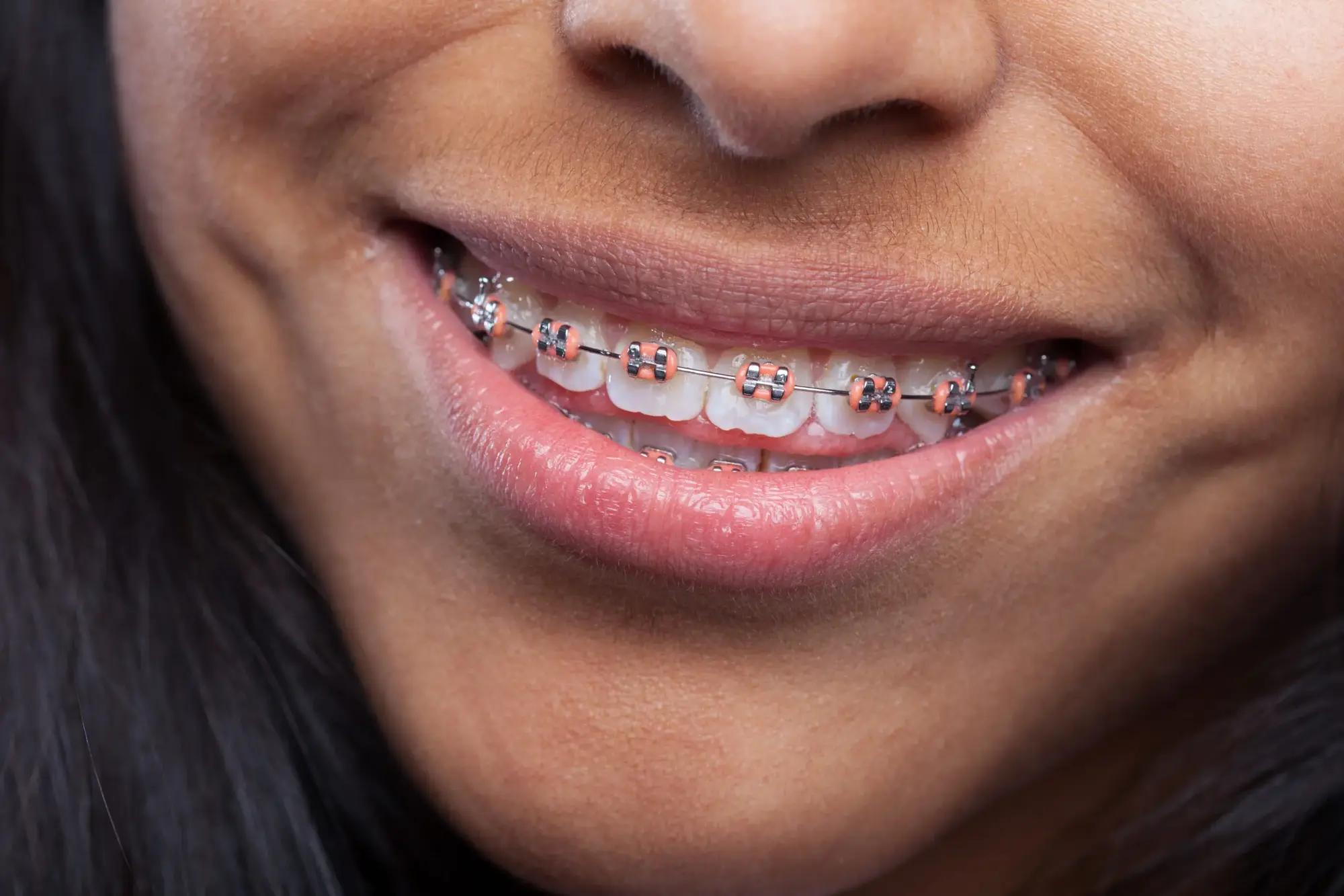 Customizing Your Braces: Fun Color Combos and Personalization Ideas