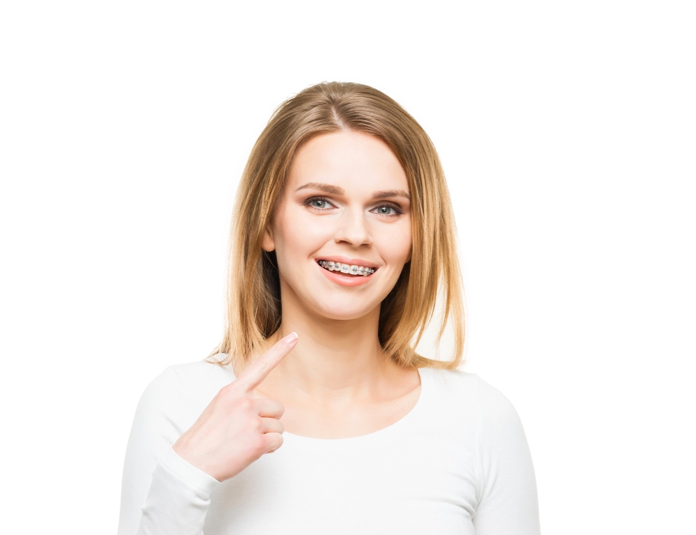 Young blonde woman pointing at her teeth with both hands and smilingn highlighting braces for overbite in Indianapolis, IN.